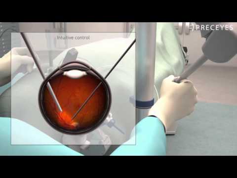 PRECEYES Surgical System